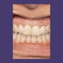 DentalCAD Flex-Lizenz Smile Creator